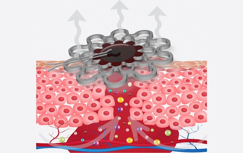 Image: The hybrid gel–paper wound dressing continuously monitors pH levels to track healing and detect chronic wound development (ACS Sens. 2025, DOI: 10.1021/acssensors.4c02172)